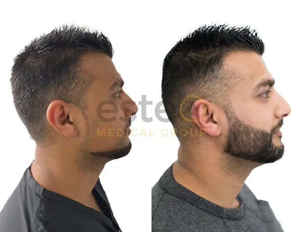 beard transplant before and after