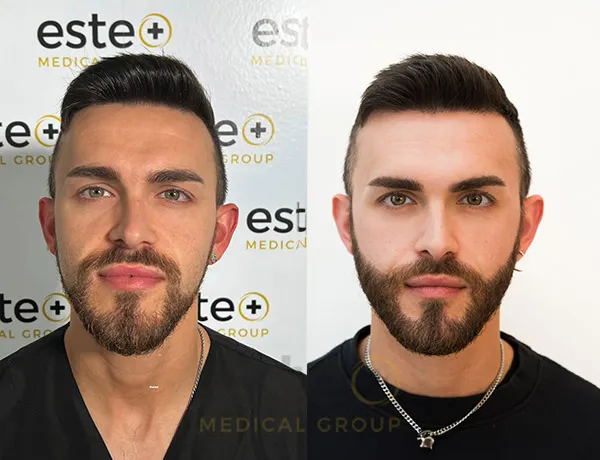 beard transplant before and after